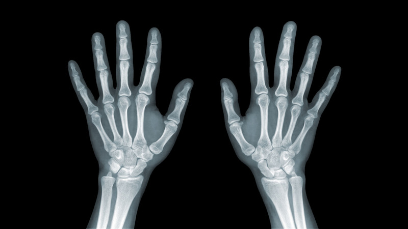 Chụp X-quang giúp chẩn đoán tốt nhất tổn thương xương